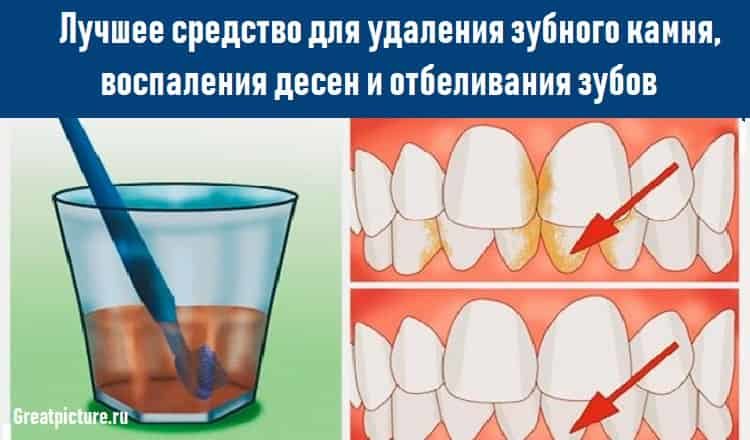 Лучшее средство для удаления зубного камня,и отбеливания зубов